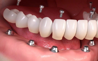 Trồng răng Implant